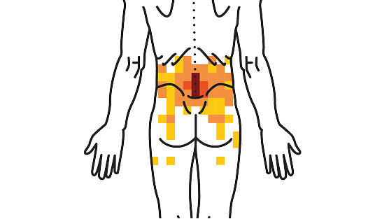 Ilustração da região lombar com áreas de dor destacadas em amarelo e vermelho
