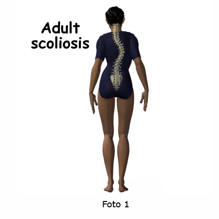 escoliose-do-adulto-01