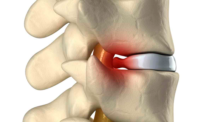 hernia-de-disco-marcus-yu-bin-pai-(1)