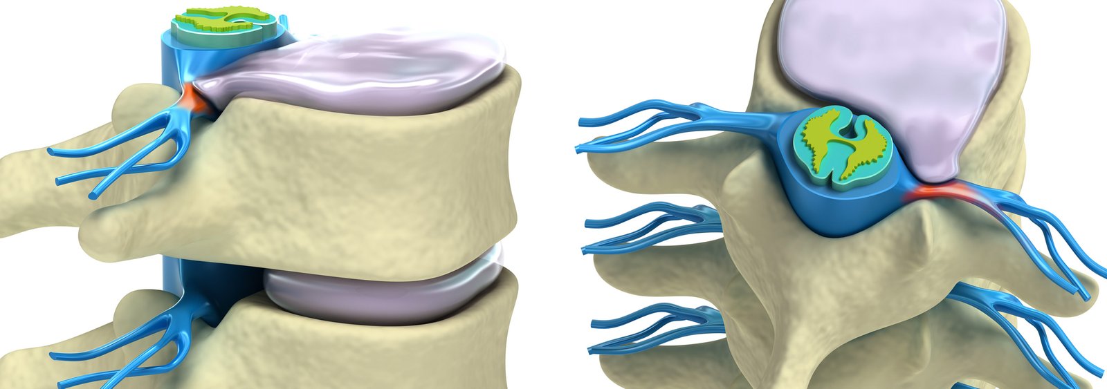 hernia-de-disco-tratamento