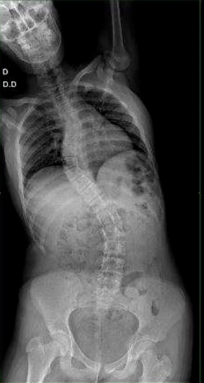 Radiografia pré-operatória de paciente de 15 anos com escoliose