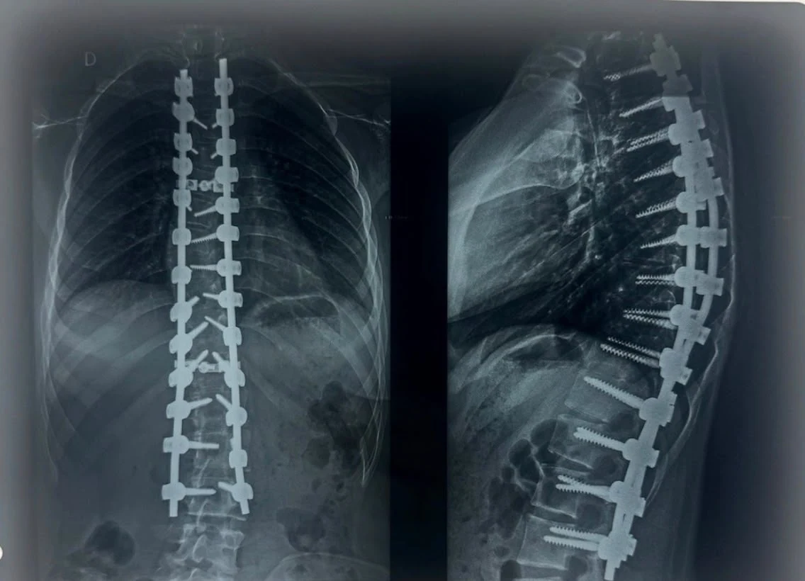 Radiografias pós-operatórias da correção de escoliose da mesma paciente